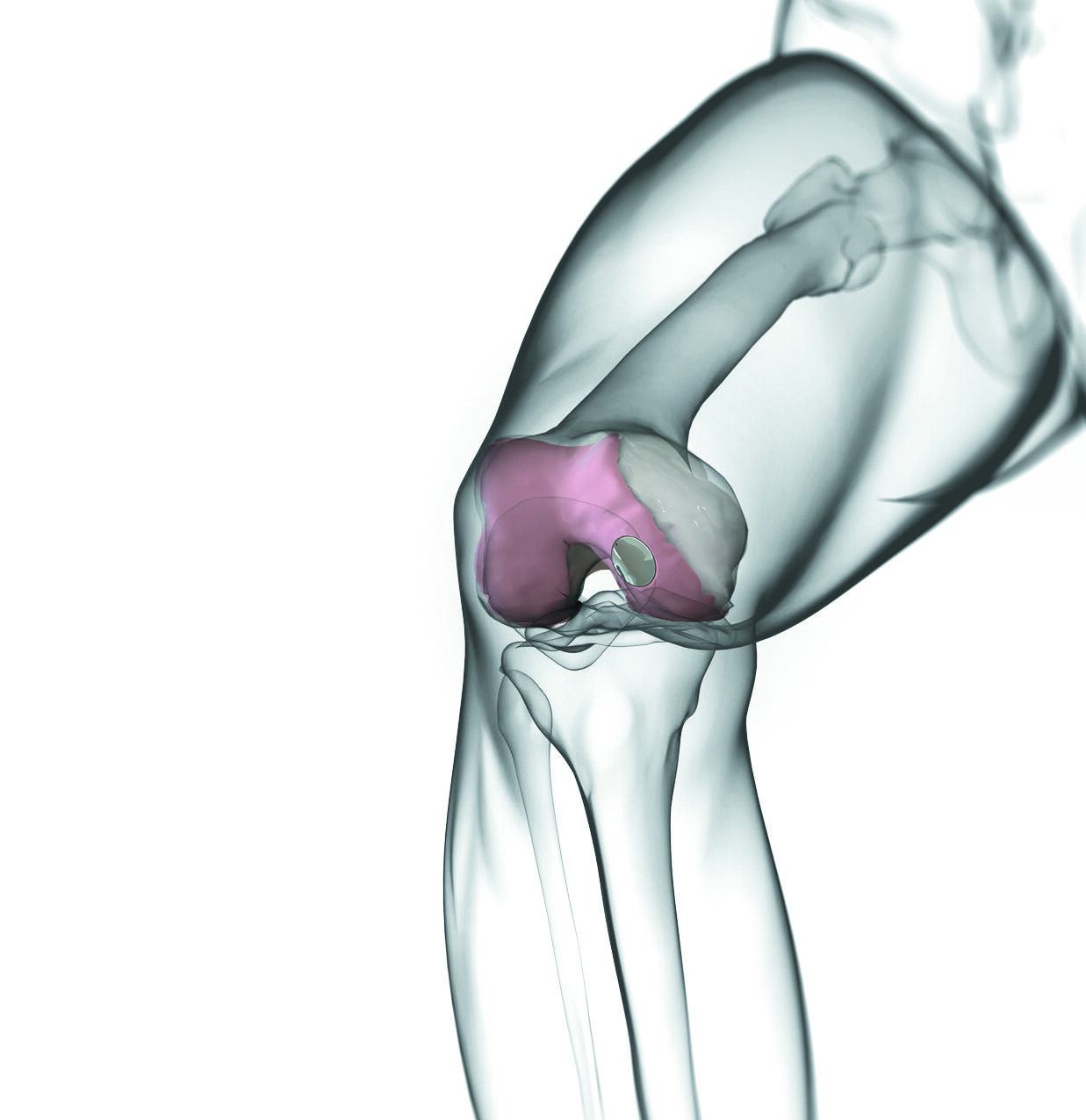 Knee implant – Episurf